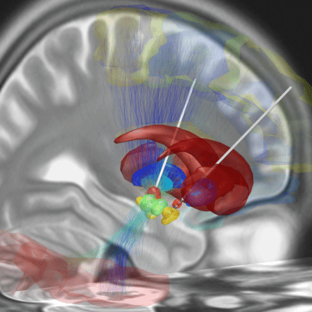 Picture of a brain from the side view. This view shows Deep Brain Stimulation probes in each hemisphere of the brain and shows the structures they pass through in different colors. The target structure is at the end of each probe.