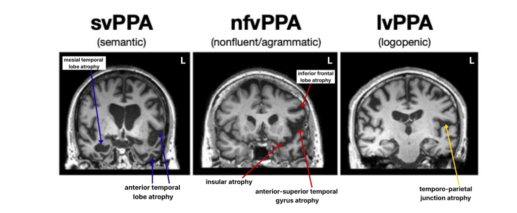 Figure: Coronal MRI Scans Showing Regional Brain Atrophy in Three Variants of Primary Progressive Aphasia

Three side-by-side coronal (cross-sectional, front-facing) brain MRI images, each labeled "L" to indicate the left side of the brain, with a heading above each identifying the PPA variant.

Left image: svPPA (semantic variant)
Two blue arrows point to areas of atrophy:

One arrow points to the mesial (inner) temporal lobe, labeled "mesial temporal lobe atrophy."
Two arrows point to the lateral temporal lobe region, labeled "anterior temporal lobe atrophy."

Middle image: nfvPPA (nonfluent/agrammatic variant)
Two red arrows point to areas of atrophy:

One arrow points to the upper lateral frontal region, labeled "inferior frontal lobe atrophy."
One arrow points to a deeper region near the temporal lobe, labeled "insular atrophy" and "anterior-superior temporal gyrus atrophy" (two separate labels pointing to nearby areas).

Right image: lvPPA (logopenic variant)
One yellow arrow points to the posterior (back) region where the temporal and parietal lobes meet, labeled "temporo-parietal junction atrophy."

Overall, the figure visually contrasts the distinct brain regions affected in each PPA subtype: temporal lobe atrophy in the semantic variant, frontal/insular atrophy in the nonfluent/agrammatic variant, and temporo-parietal atrophy in the logopenic variant.